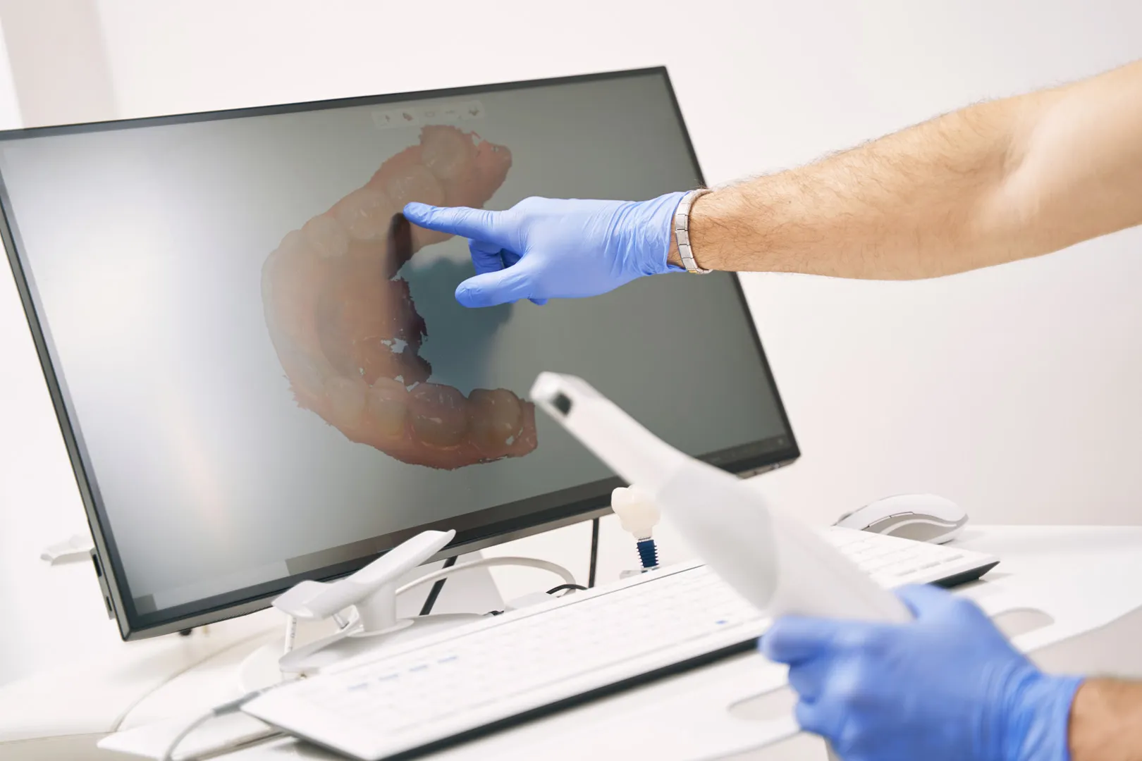 Dental Impressions