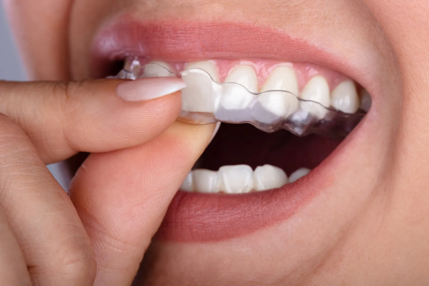 Clear Aligners (SureSmile)